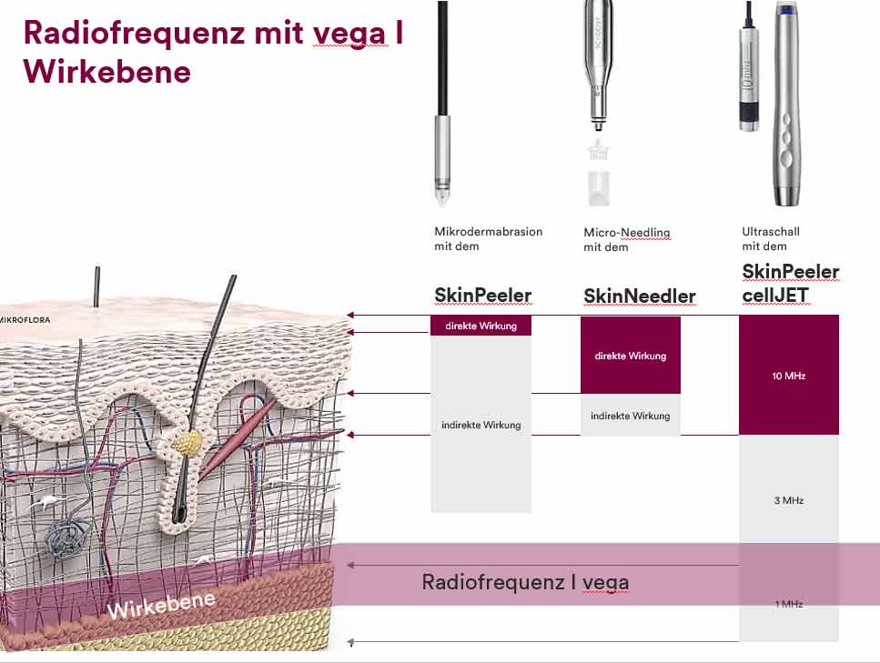 Wirkprinzip von Radiofrequenz Behandlungen