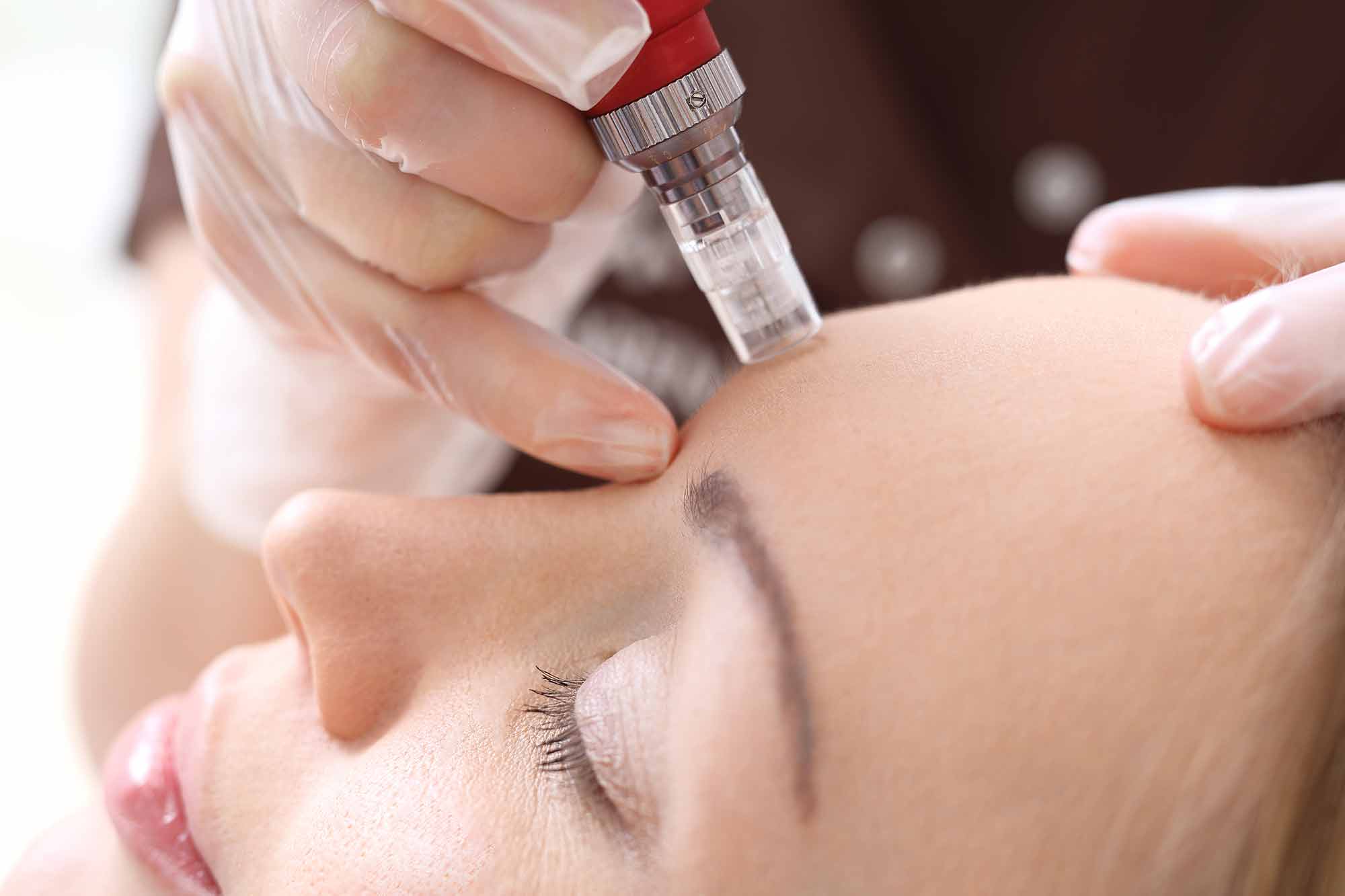 Microneedling -Hautstraffung im Beautystudio